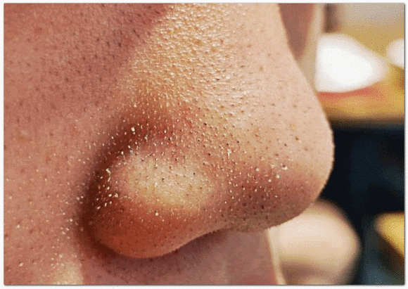 영등포여드름피부과 진료, 약 먹기 싫고 치료 통증 두렵다면? 관련 이미지 3