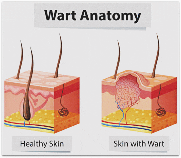 영등포사마귀, 피부 전염되는 이유와 관리 방법은? 관련 이미지 3