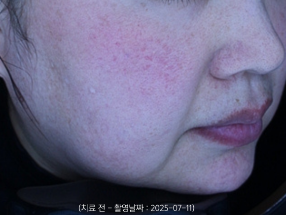 영등포 홍조치료, 안면홍조 레이저 받으면 붉은기가 좋아지나요? 관련 이미지 1