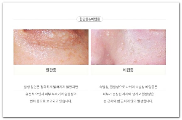 영등포편평사마귀, 병원에서 제거 전 OO부터 하는 이유 관련 이미지 6