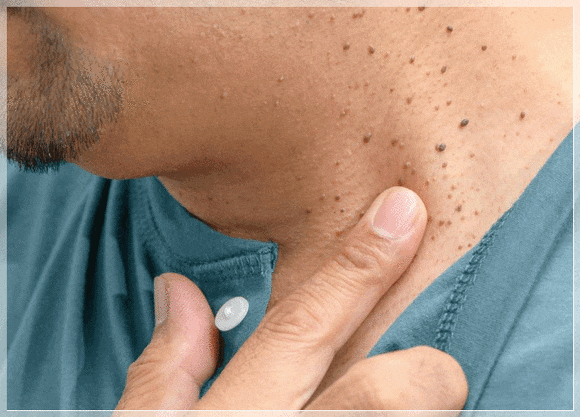 Why Flat Warts Should Be Compared First Before Undergoing Skin Tag Removal in Yeongdeungpo image 7