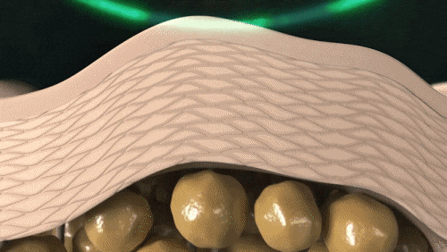 울쎄라 온다 리프팅 차이 비교, 같이 받으면 어떨까? 관련 이미지 7