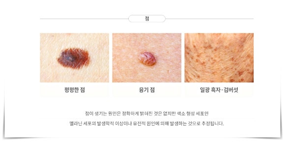 영등포점빼기 레이저 점제거 시술에 대한 오해와 진실 관련 이미지 2