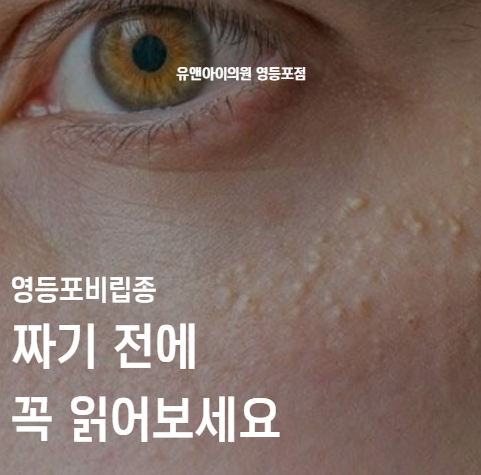 영등포 비립종 짜기 전에 꼭 읽어보세요 관련 이미지 1