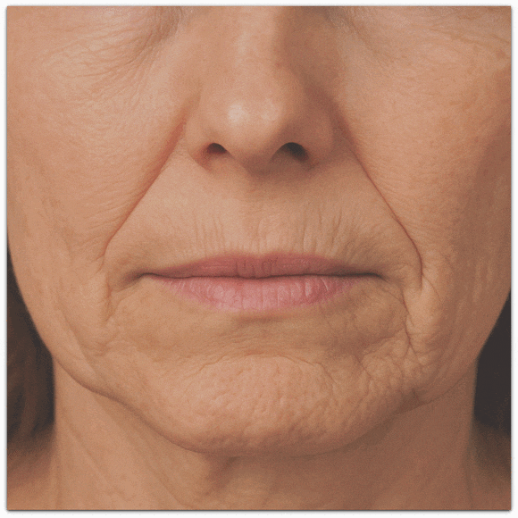 영등포 입술필러, 입술로 인상이 변할 수 있다고요? 관련 이미지 2