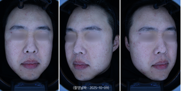 A Yeongdeungpo Man’s Blemishes and Enlarged Pores: How Were They Actually Treated? image 1
