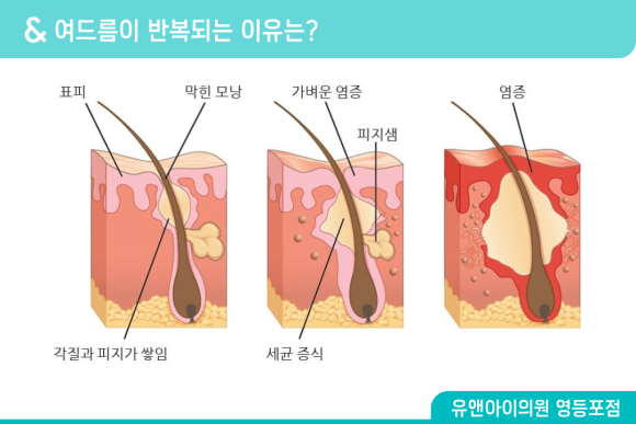 Yeongdeungpo Acne Treatment: What Should You Look at First When Acne Keeps Coming Back? image 2