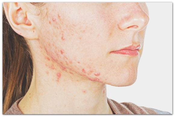 영등포여드름피부과 진료, 재발과 흉터 어떻게 막을까? 관련 이미지 4