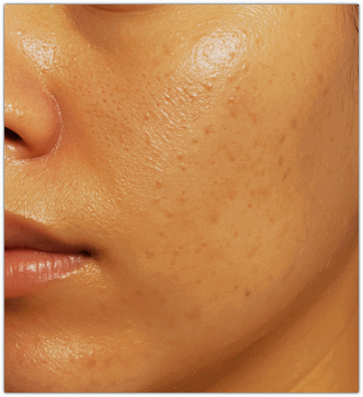 영등포여드름피부과 진료, 약 먹기 싫고 치료 통증 두렵다면? 관련 이미지 5