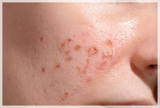 영등포엑소좀 피부 좋아지는 효과는? 관련 이미지 3