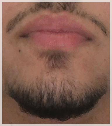 Dangsan Station Dermatology Clinic for Hair Removal, Why Treatment Suited to You Matters image 10