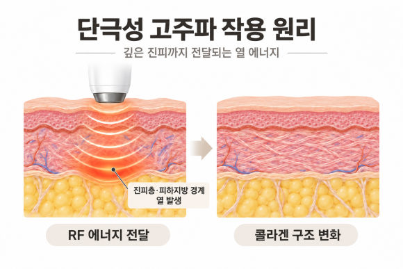 영등포써마지리프팅, 효과가 바로 나타나지 않는 이유가 궁금하다면? 관련 이미지 2