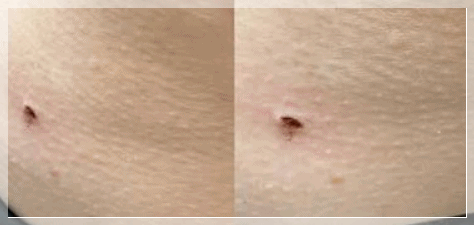 Why Flat Warts Should Be Compared First Before Undergoing Skin Tag Removal in Yeongdeungpo image 9