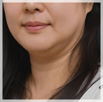 영등포 인모드리프팅, 모두에게 같은 결과가 나타나지 않는 이유 관련 이미지 4