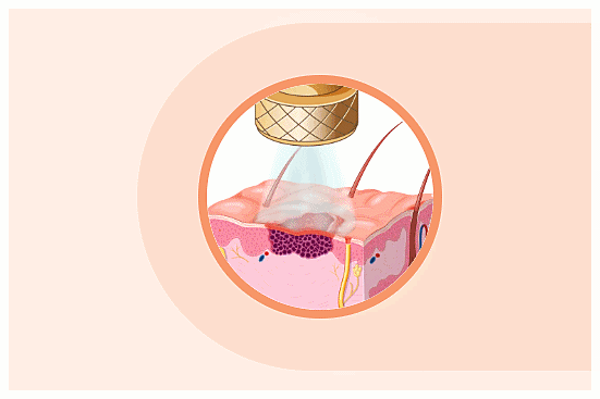 Singil-dong Dermatology Clinic: 3 Treatments That May Help During the Hot Summer image 4