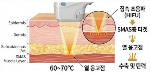 영등포울쎄라피프라임 기존 울쎄라와 어떻게 다른가요? 관련 이미지 2