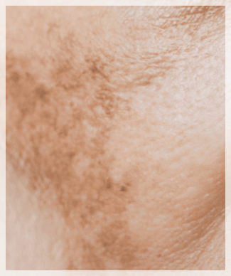 Mullae Dermatology Clinic: Differences in Skin Concerns You Should Know Before Your Appointment image 3