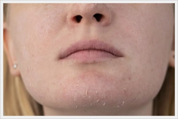 리쥬란 물광주사 차이와 효과 비교 관련 이미지 4