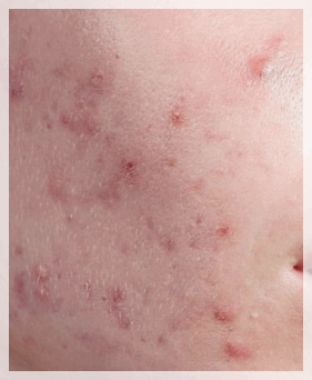 Mullae Dermatology Clinic: Differences in Skin Concerns You Should Know Before Your Appointment image 5