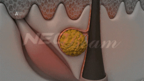 영등포여드름피부과 진료, 재발과 흉터 어떻게 막을까? 관련 이미지 2