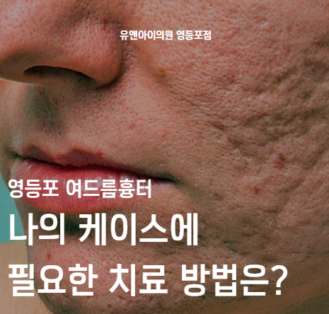 Yeongdeungpo Acne Scars: Which Treatment Does My Case Need? image 1