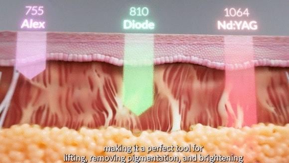 티타늄리프팅 주기 한 달 이유는? 관련 이미지 4