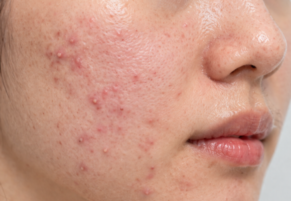 영등포 여드름 피부과 치료 잘하는 곳 찾고 있다면? 관련 이미지 7