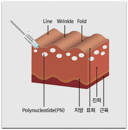 눈가 리프팅 종류, 탄력 잔주름에 효과 있는 것은? 관련 이미지 7