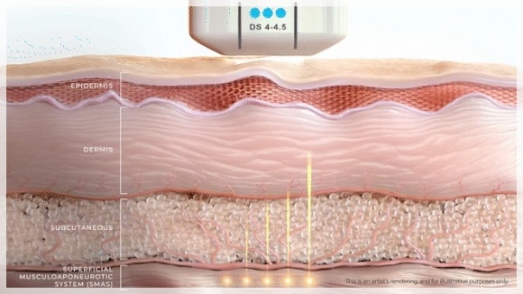 티타늄리프팅 주기 한 달 이유는? 관련 이미지 3