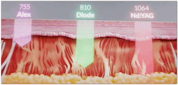 울타늄(울쎄라+티타늄) 효과, 왜 굳이 두 가지나 받을까? 관련 이미지 6