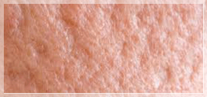 Yeongdeungpo Acne Scars: Which Treatment Does My Case Need? image 4