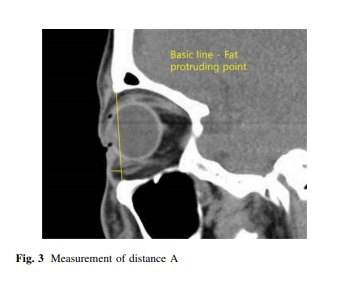 눈밑처짐 리프팅 아이울쎄라로 가능할까? 관련 이미지 1