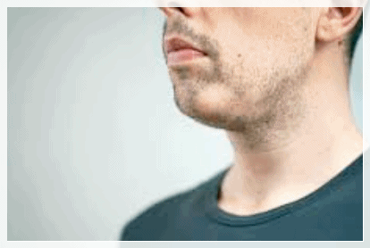 당산역 피부과 젠틀맥스, 남자 수염 제모 시 유리한 이유 관련 이미지 5