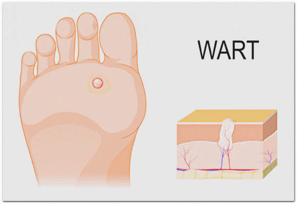 영등포사마귀, 피부 전염되는 이유와 관리 방법은? 관련 이미지 7