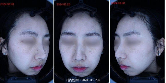 영등포 주근깨 레이저 치료 사례 관련 이미지 1