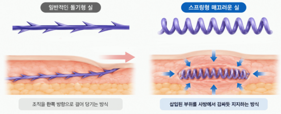 영등포실리프팅, 잼버실을 많이 넣으면 효과가 더 좋을까? 관련 이미지 5