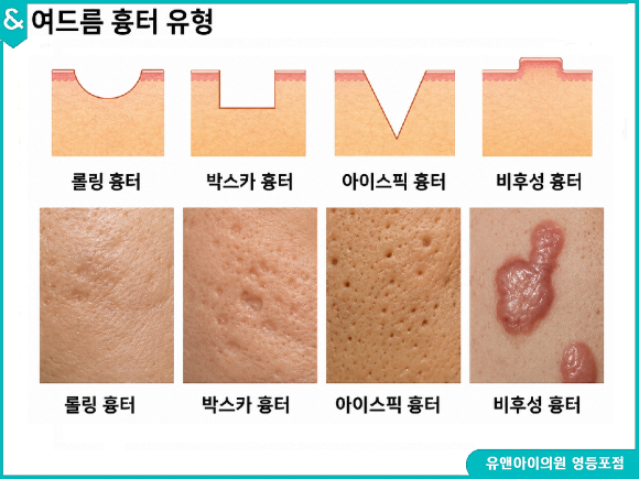 Yeongdeungpo Acne Scars: If They Concern You, You Need to Identify the Cause First image 3
