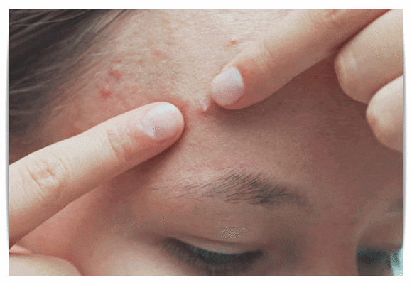 영등포여드름관리 압출해도 재발한다면? 관련 이미지 1