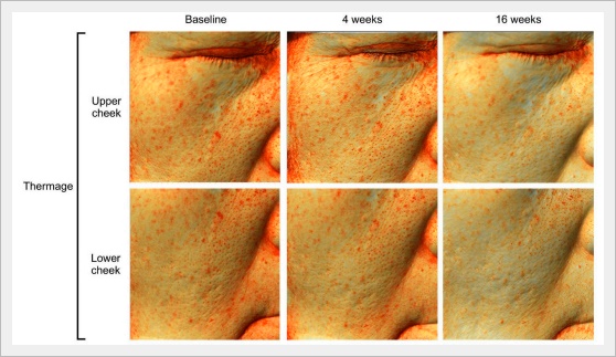 Could Thermage in Yeongdeungpo Also Help Reduce Pore Size? image 3