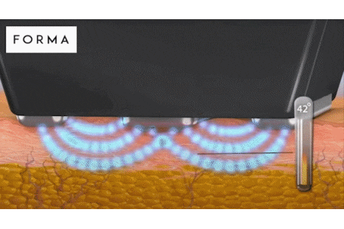 인모드 슈링크 효과 차이, 같이 받으면 어떨까? 관련 이미지 3