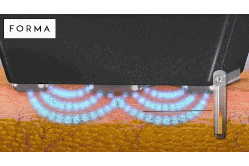 영등포인모드 리프팅 목적에 맞게 받아야 효과 봅니다 <의사 작성> 관련 이미지 3