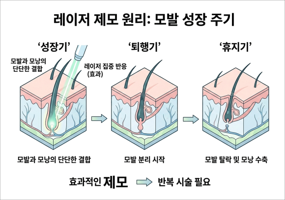 영등포젠틀맥스프로 남성 제모 쉽게 생각하면 안 되는 이유 관련 이미지 4