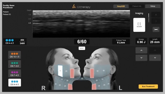 울쎄라피프라임 통증, 울쎄라보다 적을까? 관련 이미지 3