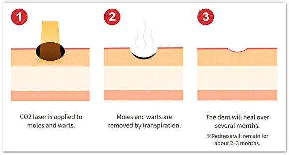 영등포점제거 깔끔하게 점빼기 가능할까? <재발 관련 내용 포함> 관련 이미지 6