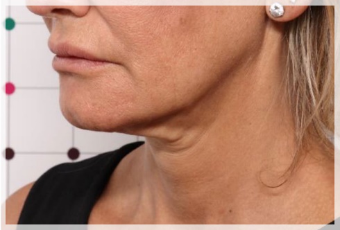 Yeongdeungpo Onda Lifting: Can It Improve a Sagging Jawline? <A Review of the Research> image 1