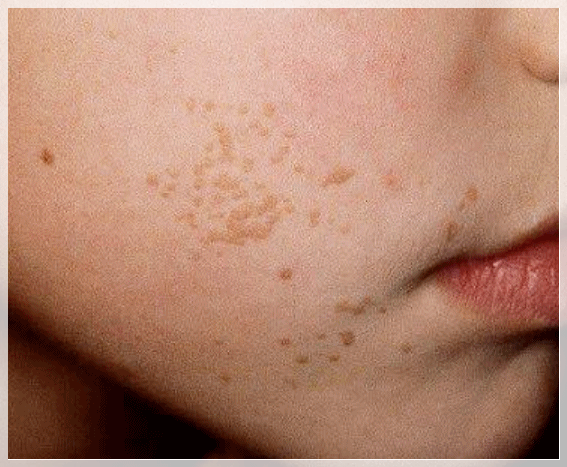 Why Flat Warts Should Be Compared First Before Undergoing Skin Tag Removal in Yeongdeungpo image 3