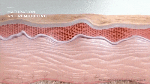 눈가 리프팅 레이저, 깊은 주름과 잔주름 모두 케어해야 한다면? 관련 이미지 9