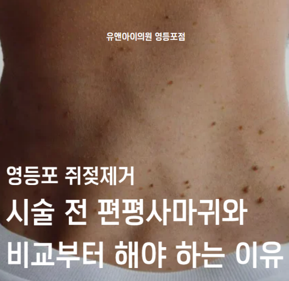 Why Flat Warts Should Be Compared First Before Undergoing Skin Tag Removal in Yeongdeungpo image 1