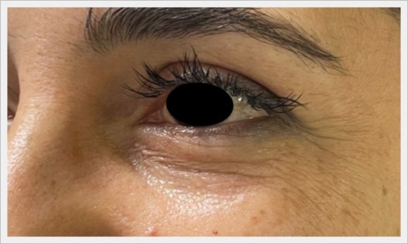 아이리쥬란 다크서클 눈가주름 개선 효과는? 관련 이미지 1