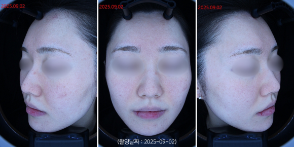 영등포 여드름 홍조 치료 사례 관련 이미지 4